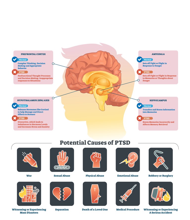 PTSD Brain And Causes Resized